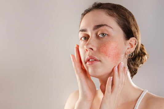 natural eczema cream for face red spots