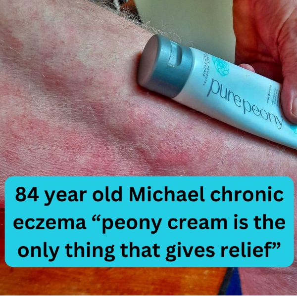 stop itchy skin at night with NZ made natural eczema cream