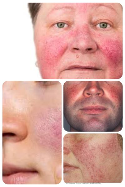 Understanding Rosacea: Causes, Triggers, and Natural Relief