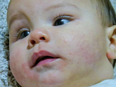 What's the best treatment for babies with eczema?