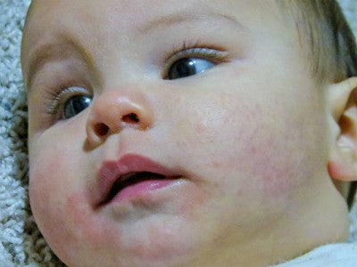 What's best for babies with eczema?