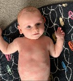 baby with eczema