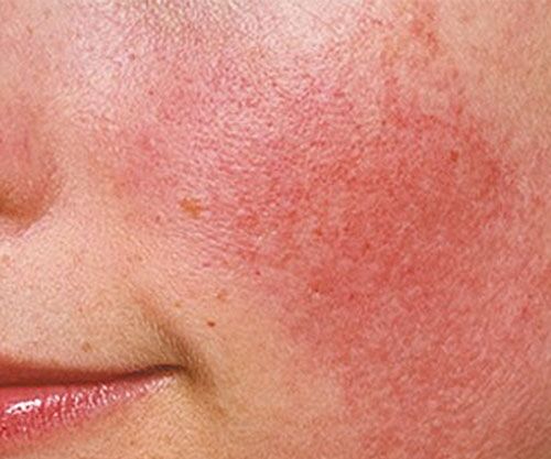Can I treat rosacea naturally?