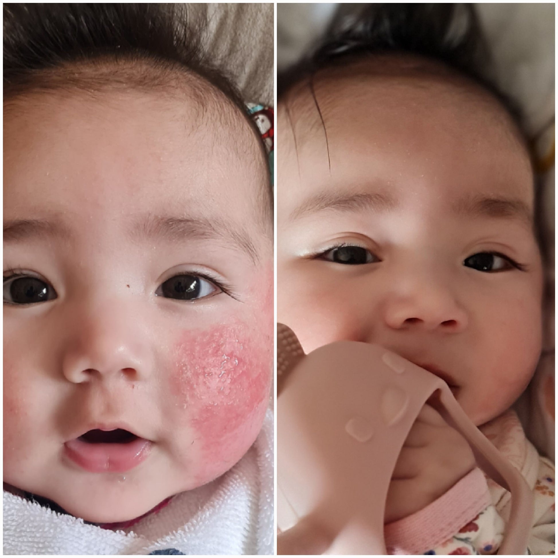 before and after photos of baby with red eczema rash onleft cheek
